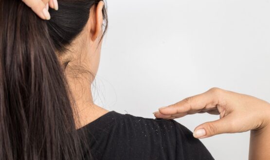 8 astuces pour limiter l’apparition des pellicules