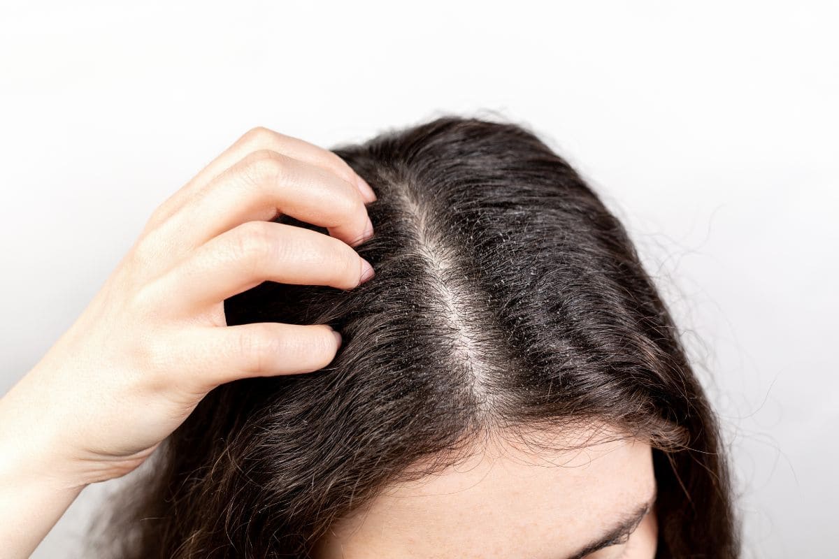 8 astuces pour limiter l’apparition des pellicules avoir des pellicules dans les cheveux